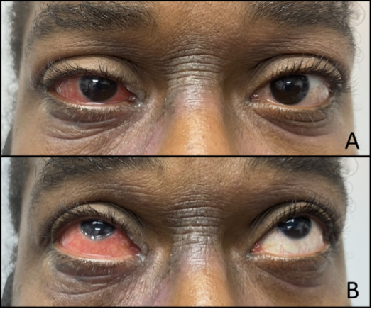 Figure 1. Dupilumab-related limbitis of the right eye.

These external photos show clinical presentation of dupilumab-related limbitis of the right eye. (A) Conjunctivitis with limbitis OD at initial presentation in primary gaze. Notable findings include Dennie lines OD > OS and limbitis with significant injection and chemosis OD. (B) Conjunctivitis with limbitis OD at initial presentation in upgaze, revealing significant limbal and conjunctival hyperemia.