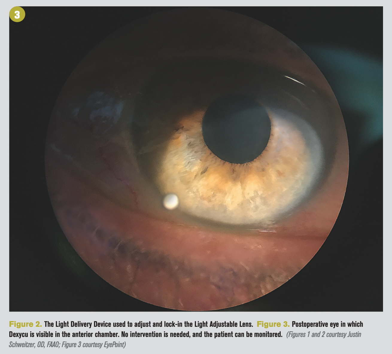 Cataract surgery 2020 update