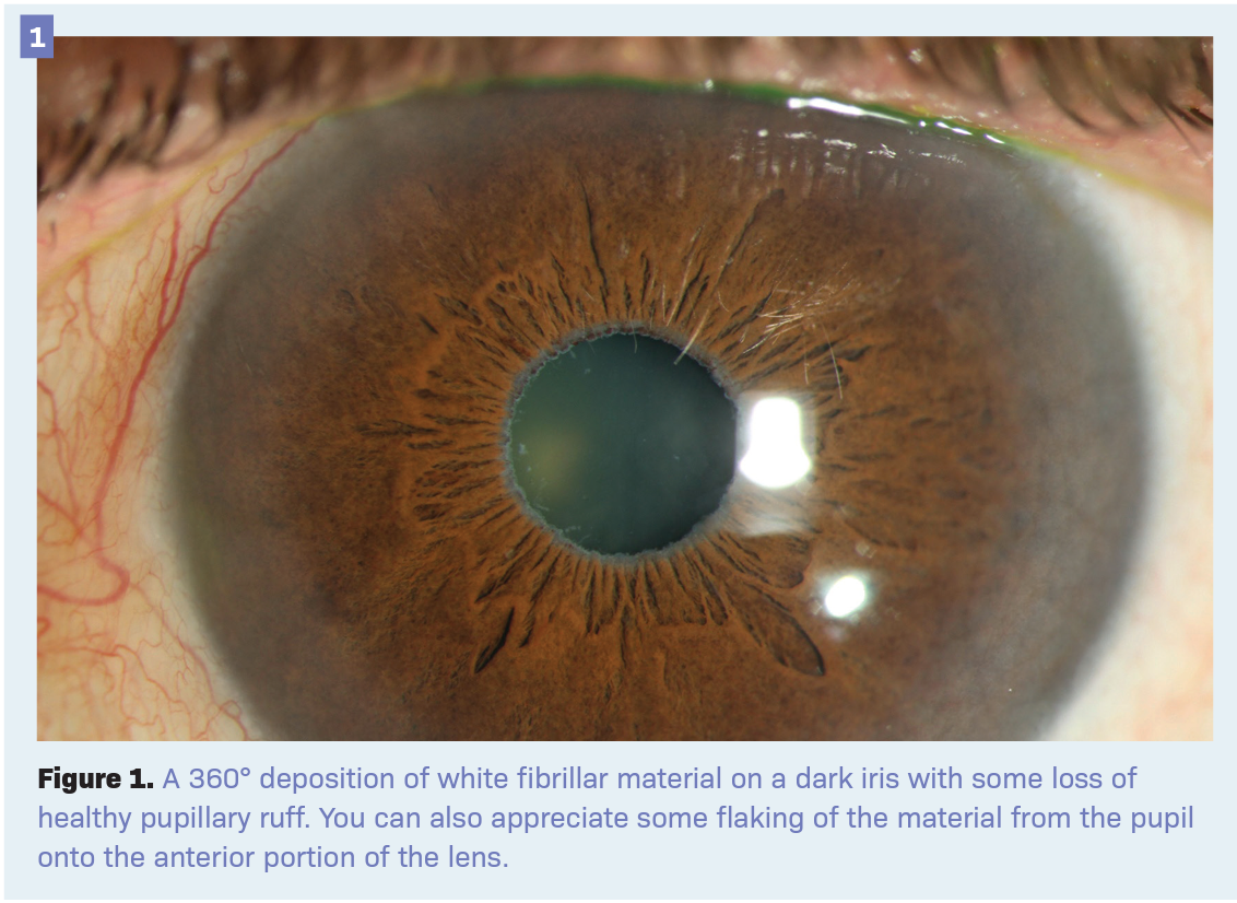 Figure 1. A 360° deposition of white fibrillar material on a dark iris with some loss of healthy pupillary ruff. You can also appreciate some flaking of the material from the pupil onto the anterior portion of the lens.