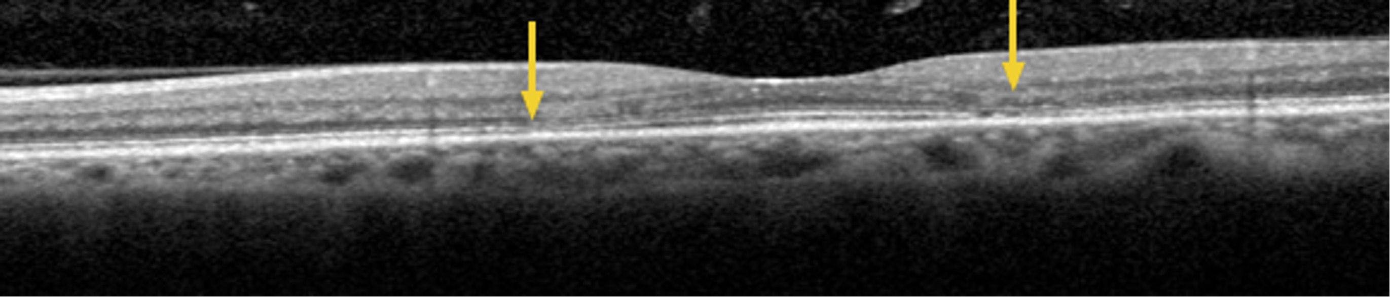 Figure 6. SD-OCT imaging of the right eye with the scan line adjusted to the area just below the fovea. Arrows point to a more obvious area of attenuation of the ELM and IS/OS line temporal to the fovea and a more subtle area of early attenuation nasal to the fovea.