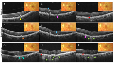 Figure 3. Optical coherence tomography biomarkers and features of geographic atrophy in the left eye showing progression over 4 years. Color fundus photo insets show OCT B-scan location (white line). Baseline: A, B, C. 2-year follow-up: D, E, F. 4-year follow-up: G, H, I. Left column: A hyporeflective drusen core (yellow arrowhead) develops iRORA within 4 years, represented by RPE and photoreceptor disruption and underlying choroidal hypertransmission (teal arrowhead). At the 2-year follow-up, a subretinal drusenoid deposit (orange arrowhead) is noted adjacent to the druse. Middle column: A large soft druse with an
overlying intraretinal hyperreflective foci (blue arrowhead) develops cRORA within 4 years. At baseline, an adjacent hyperreflective crystalline deposit (pink arrowhead) is noted, an overlying intraretinal hyperreflective foci is noted at the 2-year follow-up and this area
develops cRORA at 4 years. Subsidence of the inner nuclear and outer plexiform layers and homogenous choroidal hypertransmission (green arrowheads) is appreciated at the sites of cRORA. An adjacent area of iRORA develops nasally with subsidence of the outer plexiform and inner nuclear layers (red arrowhead), hyporeflective wedges and choroidal
hypertransmission at the 4-year follow-up. Right column: An area of iRORA at baseline denoted by outer plexiform and inner nuclear layer subsidence (red arrowhead) converts to cRORA within 2 years with homogenous choroidal hypertransmission (green arrowheads). At
the 2-year follow-up an adjacent hyperreflective crystalline deposit (pink arrowhead) is noted nasally which progresses to iRORA by the 4-year follow-up with subsidence of the outer plexiform and inner nuclear layers (red arrowhead), a hyporeflective wedge and variable choroidal hypertransmission. cRORA: Complete RPE and outer retinal atrophy. iRORA: Incomplete RPE and outer retinal atrophy; RPE: retinal pigment epithelium (Figures courtesy of Ethan Wohlgemuth, OD)
