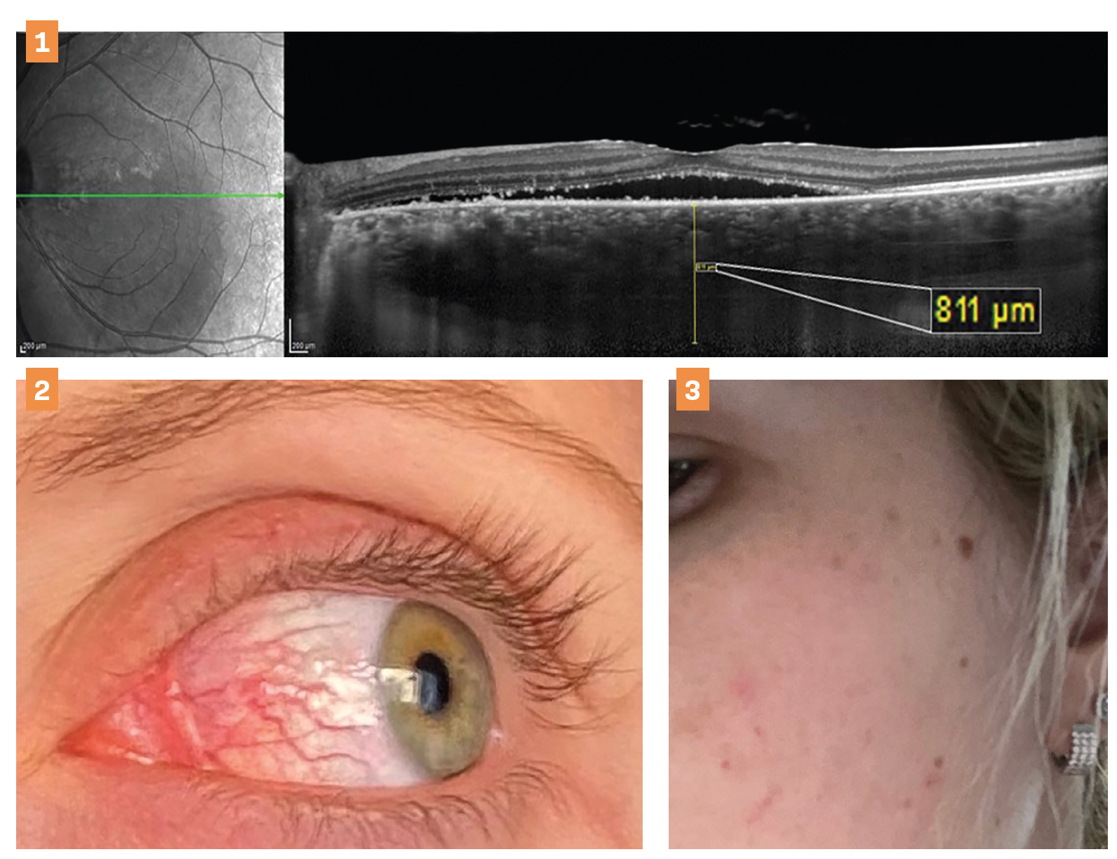 Figure 1. A 28-year-old woman in her second trimester came in complaining of visual loss. This patient received a diagnosis of central serous retinopathy that eventually self-resolved. Image courtesy of Suzanne W. Sherman, OD, FAAO, FSLS, Dip ABO.

Figure 2. Episcleritis commonly seen in patients with underlying autoimmune conditions. Image courtesy of Christina Cherny, OD.

Figure 3. A 30-year-old woman presents 3 months' post partum with “mask of pregnancy.” This is prophylactic PRP performed on a patient with type 1 diabetes who was pregnant. Image courtesy of Royce Chen, MD.