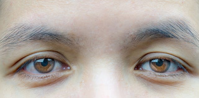 Anophthalmic ptosis and enucleation effects on upper eyelid function