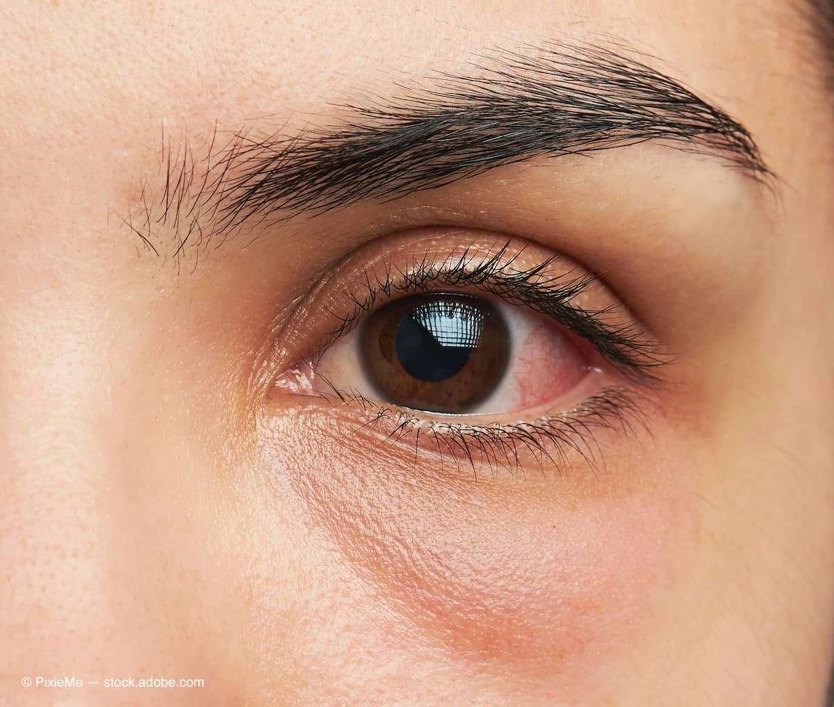 eye with infection (Adobe Stock / PixieMe)
