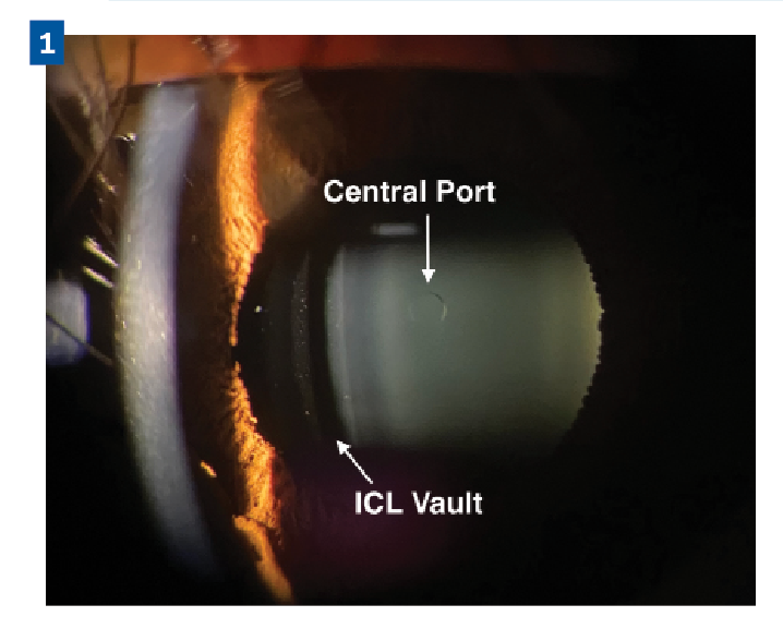 Figure 1.The EVO ICL 360-µm central port allows sufficient aqueous flow from the posterior chamber to the anterior chamber.