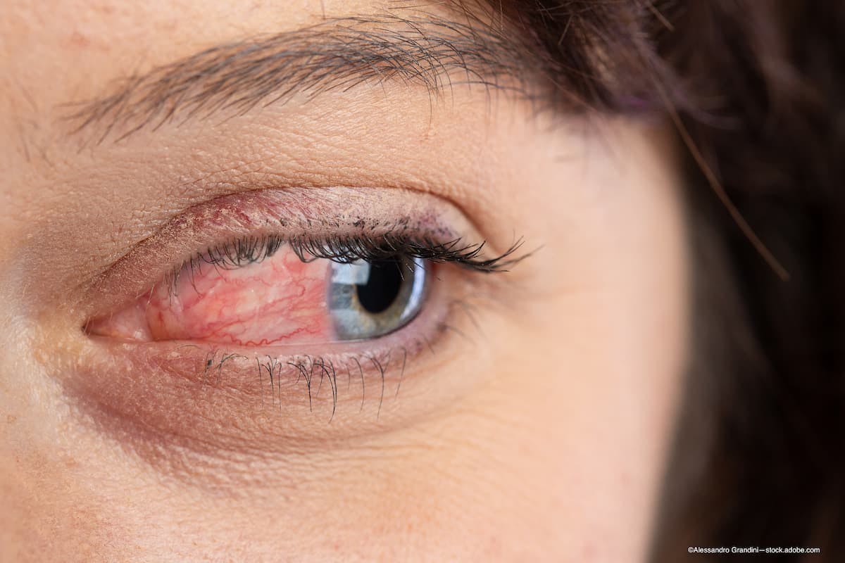 eye irritation following eye drop use from FDA recall, AOA releases statement - ©Alessandro Grandini