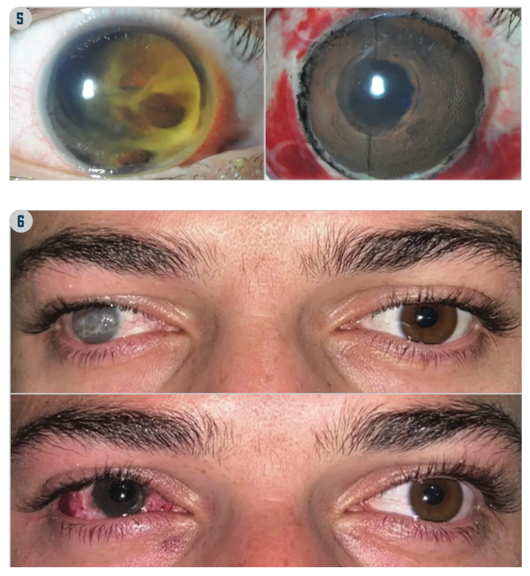 FIGURE 5. Manual Intrastromal Keratopigmentation and Pupil Simulation With Superficial Automated Keratopigmentation. Total corneal leucoma (left) and result after treatment with femtosecond- assisted intrastromal keratopigmentation and superficial automated keratopigmentation for the pupil (right).  FIGURE 6. Keratopigmentation With Strabismus Surgery. Preoperative appearance before keratopigmentation and squint surgery (top) and postoperative result (right). (Images courtesy of Jorge L. Alió, MD, PhD, FEBOphth)