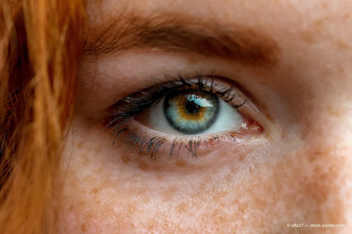 Close up of one eye of young red ginger freckled woman with perfect healthy freckled skin, looking at camera. (Adobe Stock / alfa27)