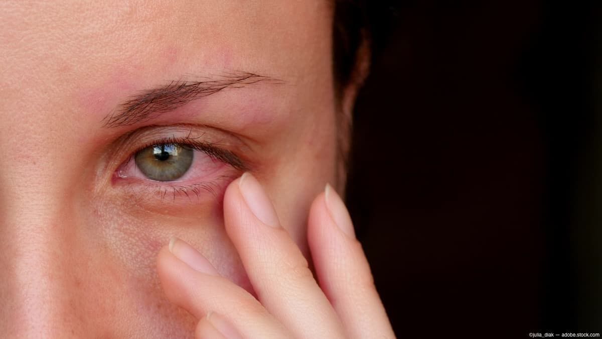 Woman with inflamed eye touching face Image Credit: AdobeStock/julia_diak