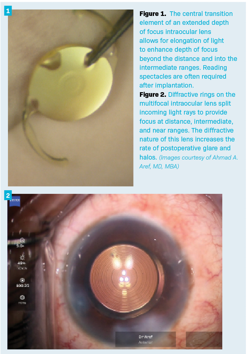 Figure 1.  The central transition element of an extended depth of focus intraocular lens allows for elongation of light to enhance depth of focus beyond the distance and into the intermediate ranges. Reading spectacles are often required after implantation.  Figure 2. Diffractive rings on the multifocal intraocular lens split incoming light rays to provide focus at distance, intermediate, and near ranges. The diffractive nature of this lens increases the rate of postoperative glare and halos. (Images courtesy of Ahmad A. Aref, MD, MBA)