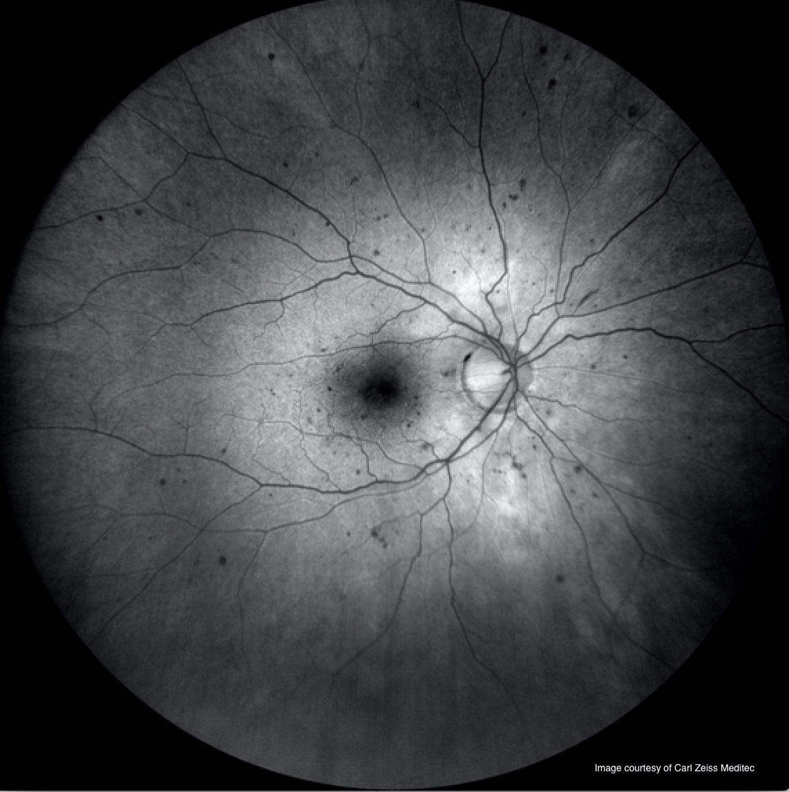 When to refer patients with diabetic retinopathy