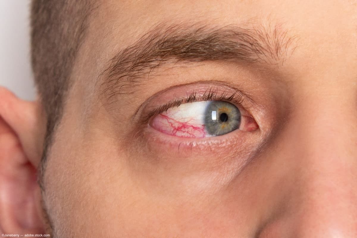 Uveitis in eye of a man Image Credit: AdobeStock/Janeberry