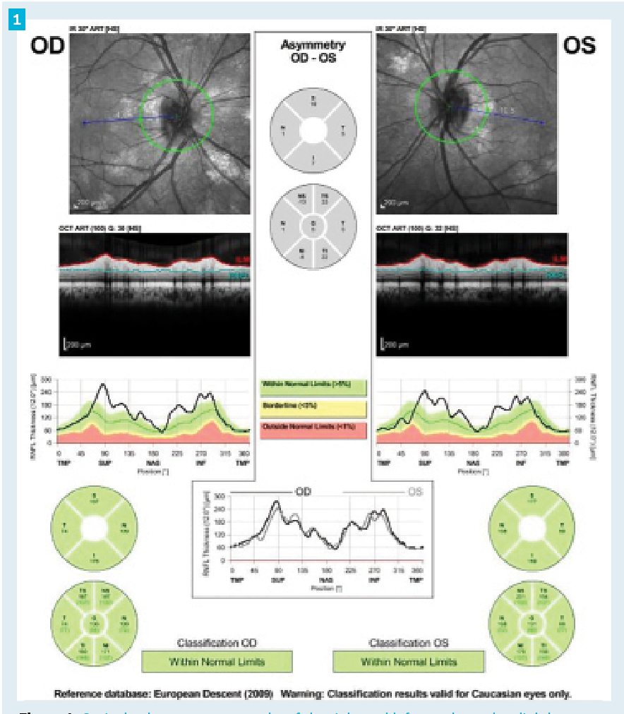 Figure 1. Optical coherence tomography of the right and left eye showed a slightly thickened retinal nerve fiber layer in each eye. Of note, infrared imaging revealed multiple bright chorodial lesions surrounding the opic nerve in each eye. 