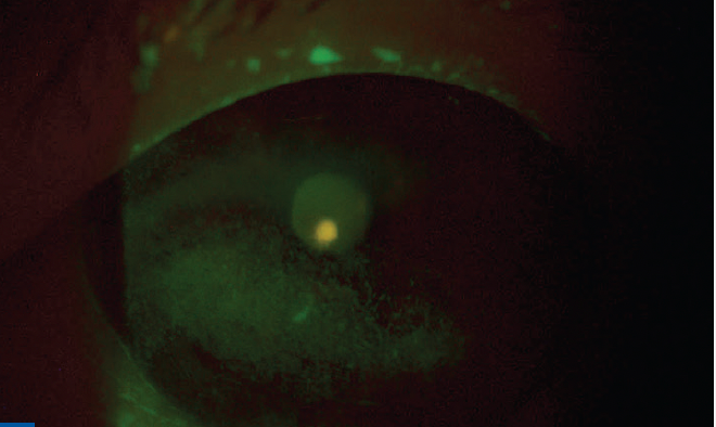 Cryopreserved amniotic membrane excels at healing ocular surface wounds