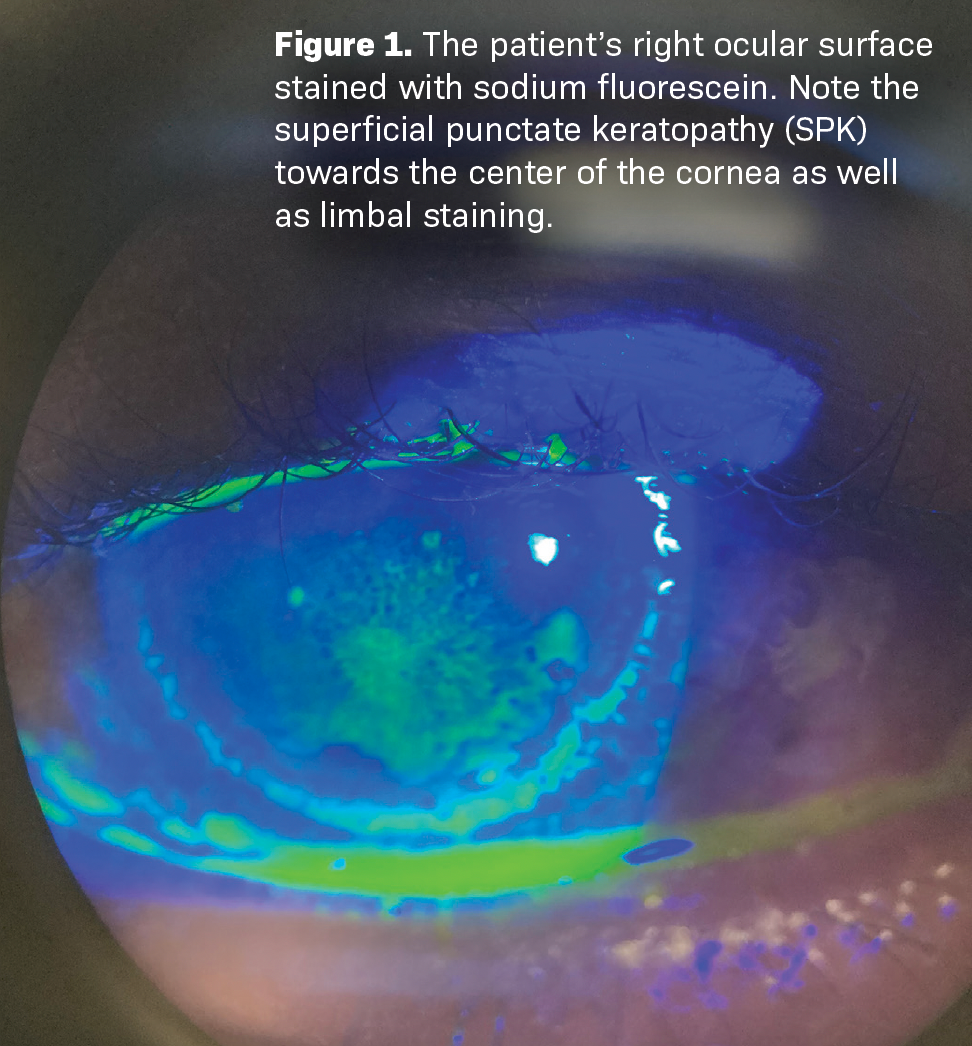 Contact lens overwear leads to short-term, long-term consequences