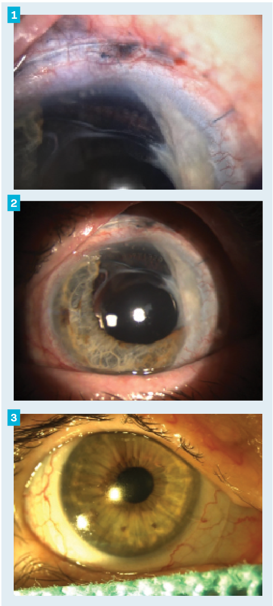 Figures 1 and 2. Case 1 - Image of scleral lens on-eye highlighting the location of the conjunctival sutures OS.

Figure 3. Case 2 - Final scleral lens fit therapeutically to address punctate epithelial erosions and central epitheliopathy with haze OD.

(Images courtesy of Thomas A. Wong, OD, FNAP.)
