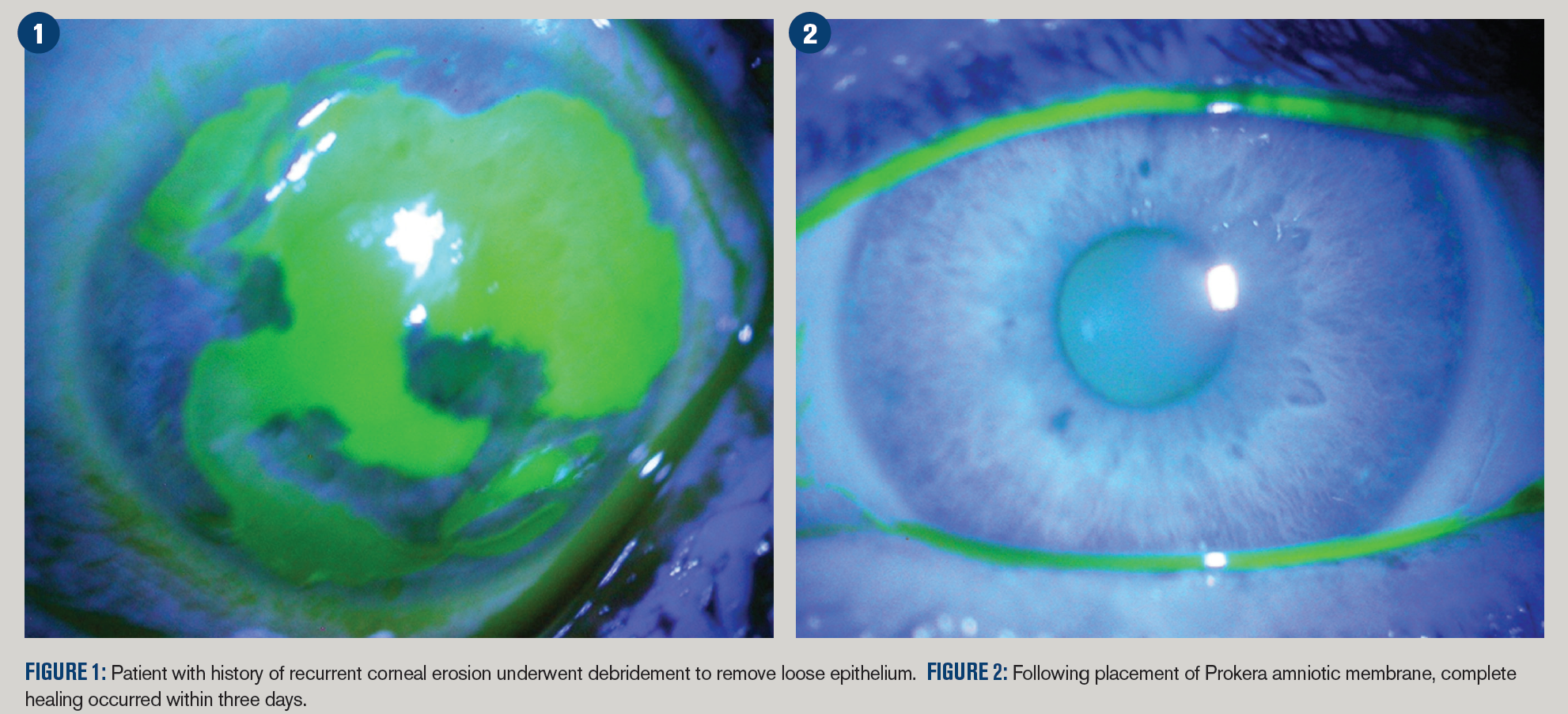 Go beyond medical treatment for recurrent corneal erosion 