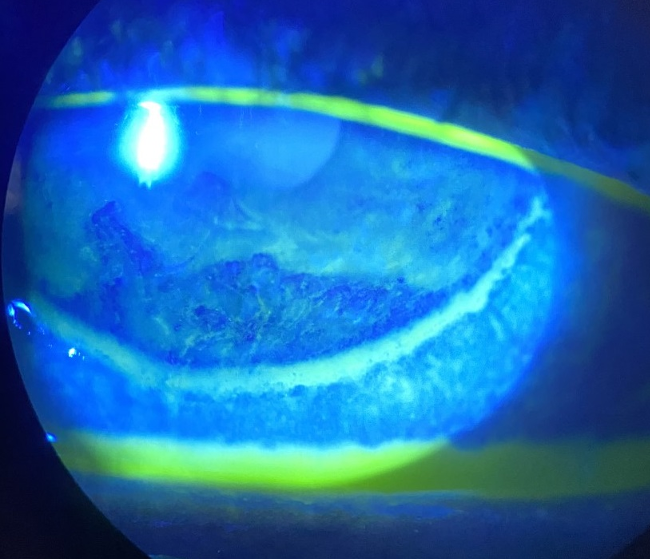 Figure 2. Right eye after sodium fluorescein instillation. Slit lamp photography shows the right eye after instillation of sodium fluorescein. Poor ocular surface wetting and tear pooling at the corneo-scleral junction are evident.

(Images courtesy of Kent Uehara, OD, FAAO)