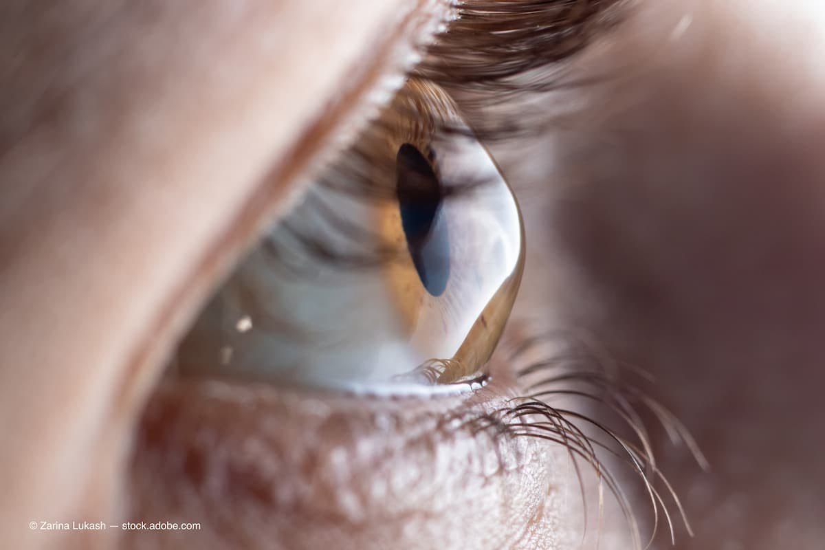 Keratoconus and perfect vision: Is it possible?