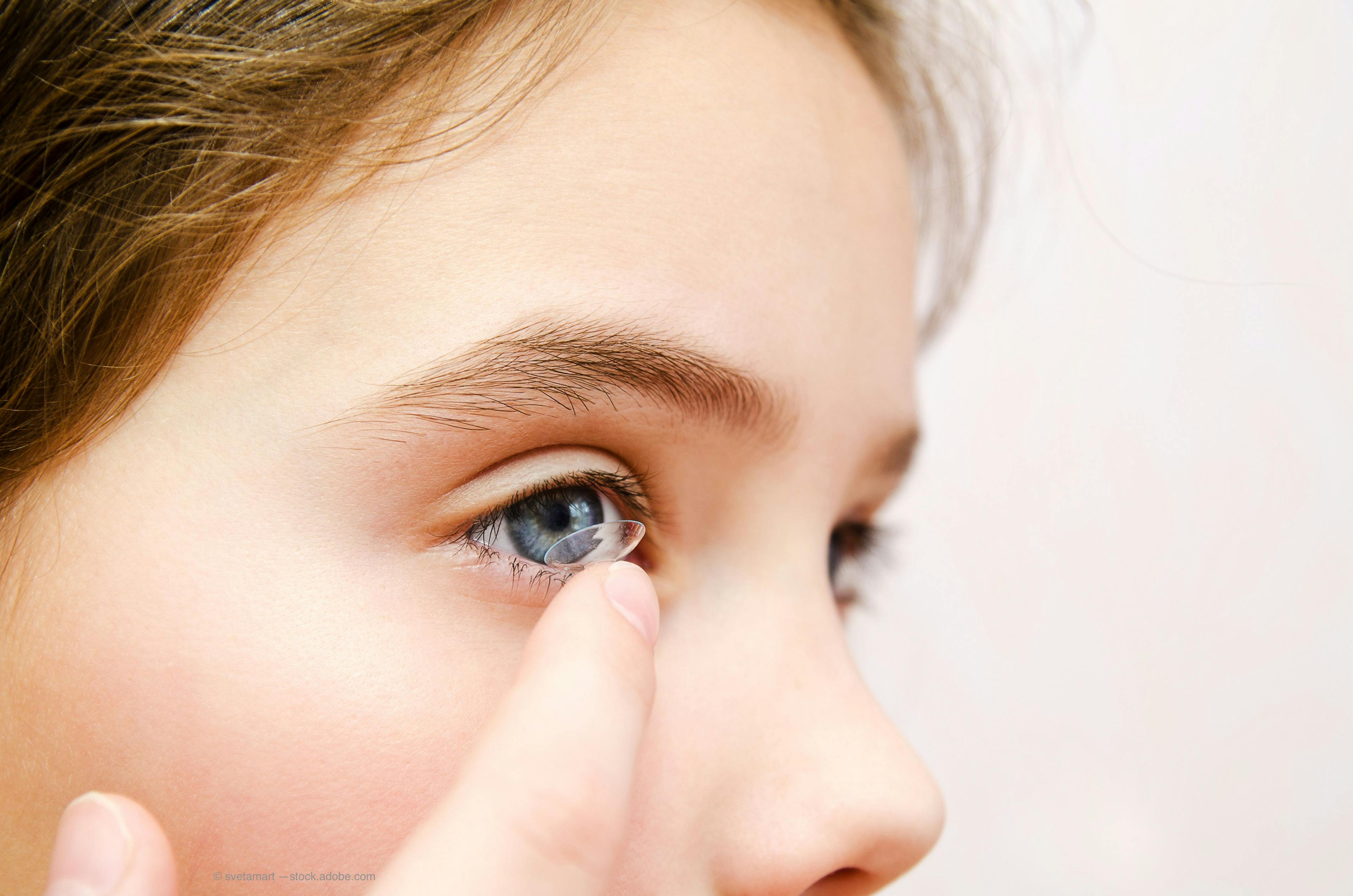 4 tips for pediatric contact lens fittings