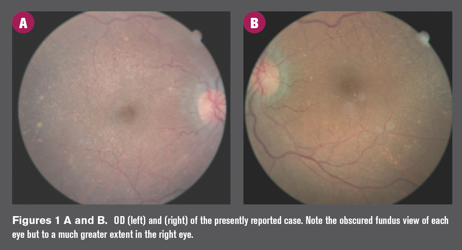 OCT in DR follow-up highlights importance of retina-vitreous attachment