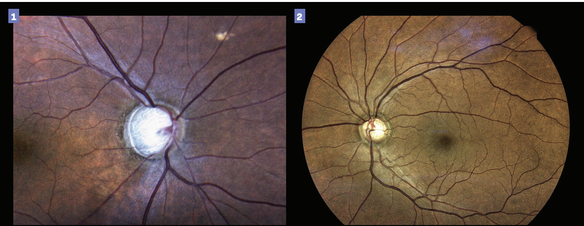 Figure 1. Severe thinning of the optic nerve. Glaucoma has reached the severe stage at this point, likely requiring a low IOP target. Figure 2. Large optic disk cupping. (Images courtesy of Gleb Sukhovolskiy, OD)