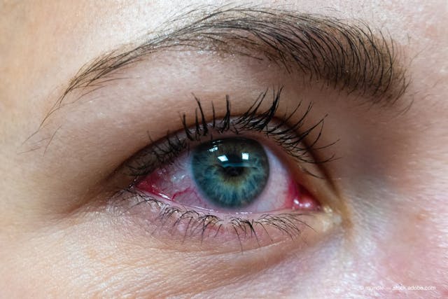 Can cyclosporine solutions be used to treat allergic conjunctivitis? 