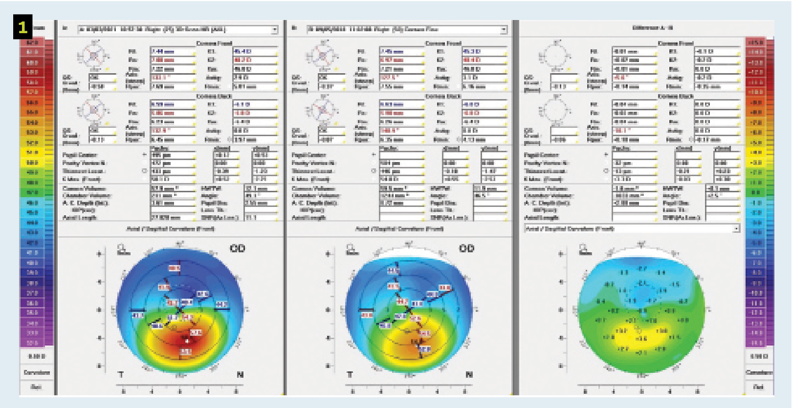 This comparison map shows progression that occurred over a 2.5-year period in the right eye of a patient with KC following an unapproved epi-on cross-linking procedure but before an iLink epi-cross-linking procedure.