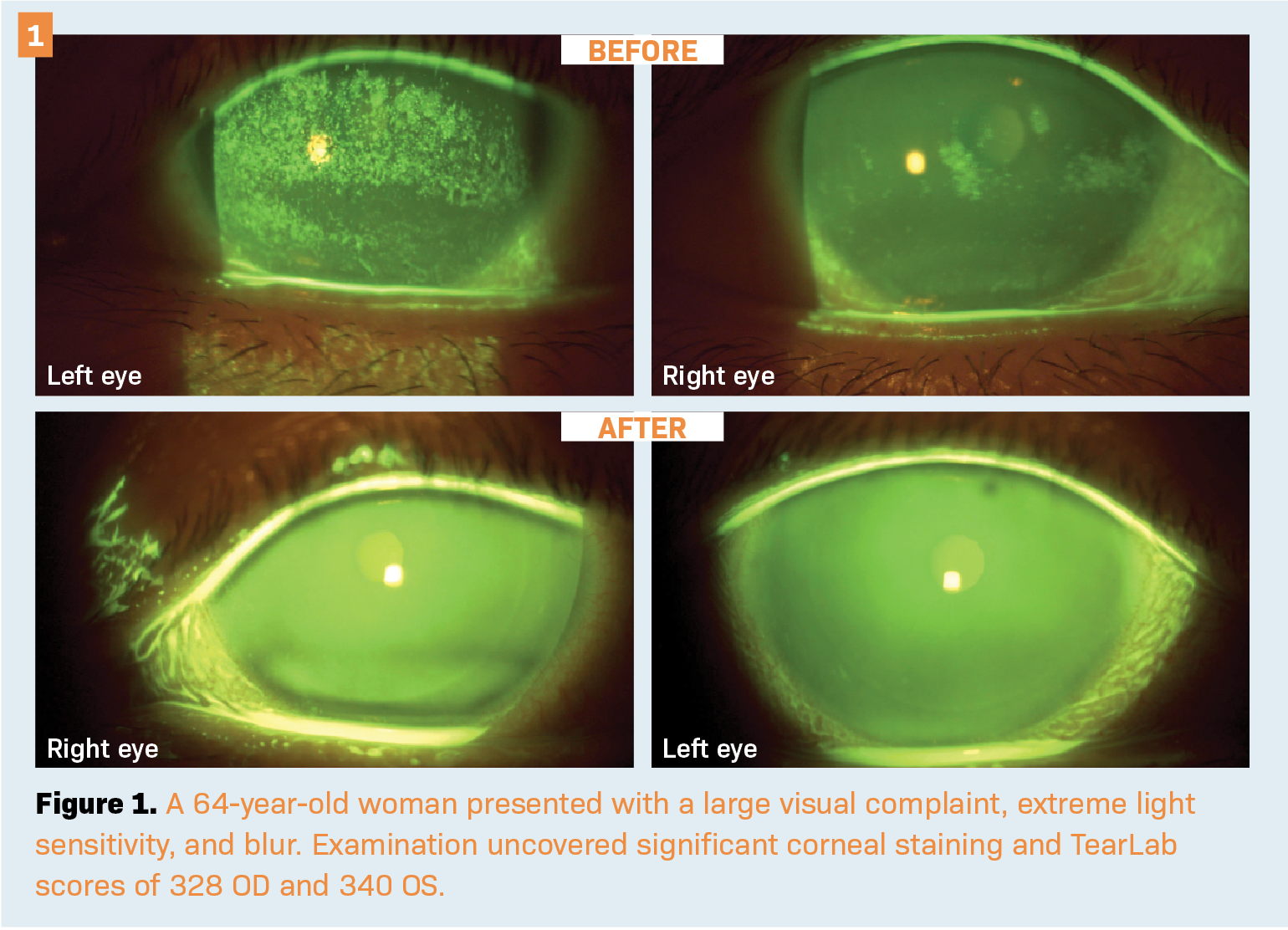 A 64-year-old woman presented with a large visual complaint, extreme light sensitivity, and blur. Examination uncovered significant corneal staining and TearLab scores of 328 OD and 340 OS. 