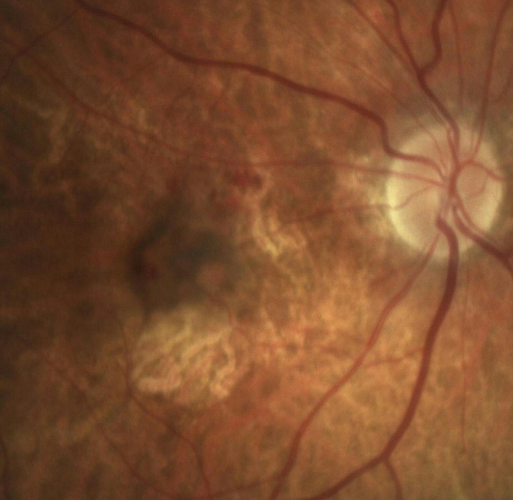Color fundus photograph. (Image courtesy of M. Rafieetary, OD.)