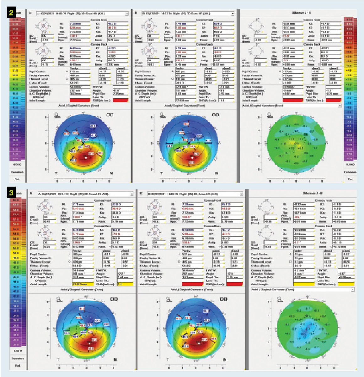 Figures 2 and 3. Topographic changes are common in the early postprocedure period before the cornea stabilizes. This comparison map shows the cornea before iLink treatment and 2 months and 1 year after iLink treatment. (Images courtesy of Florencia Yeh, OD, FAAO, FSLS)