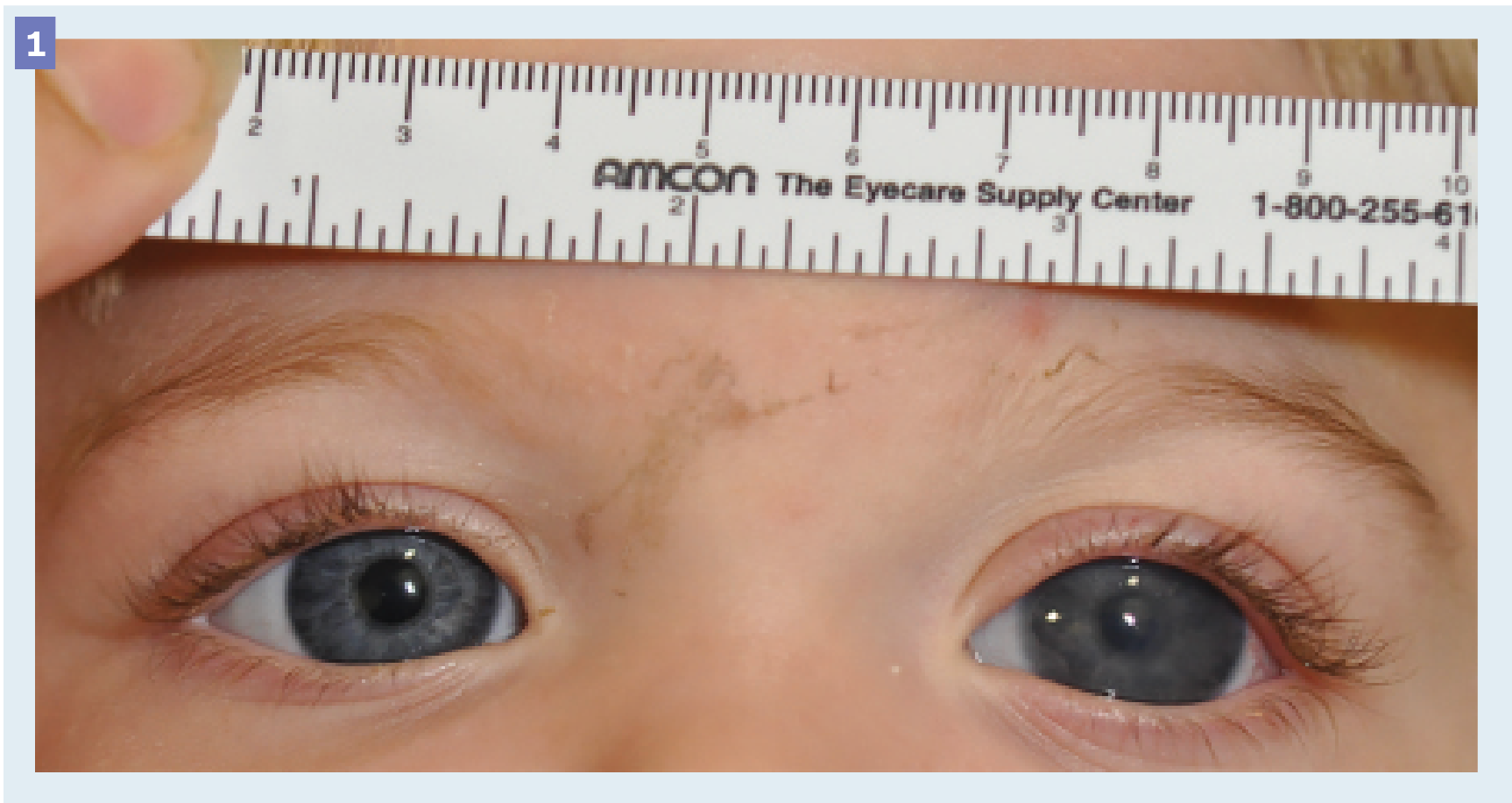 Figure 1. Pediatric Congenital Glaucoma. A photo of a 15-month-old male patient with congenital glaucoma shows an enlarged cornea with clouding of left eye.