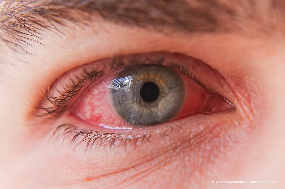 Macro closeup of conjunctivitis infeced red eye (Adobe Stock / Audrius Merfeldas)