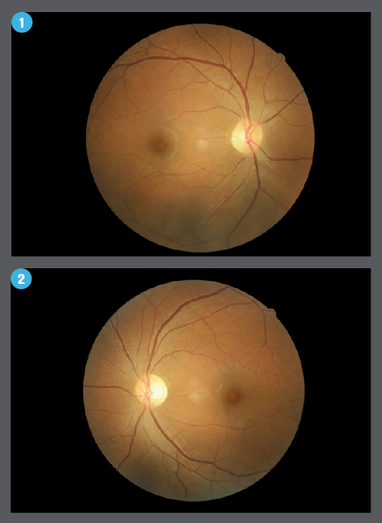 Fig 1 and 2 of retinas