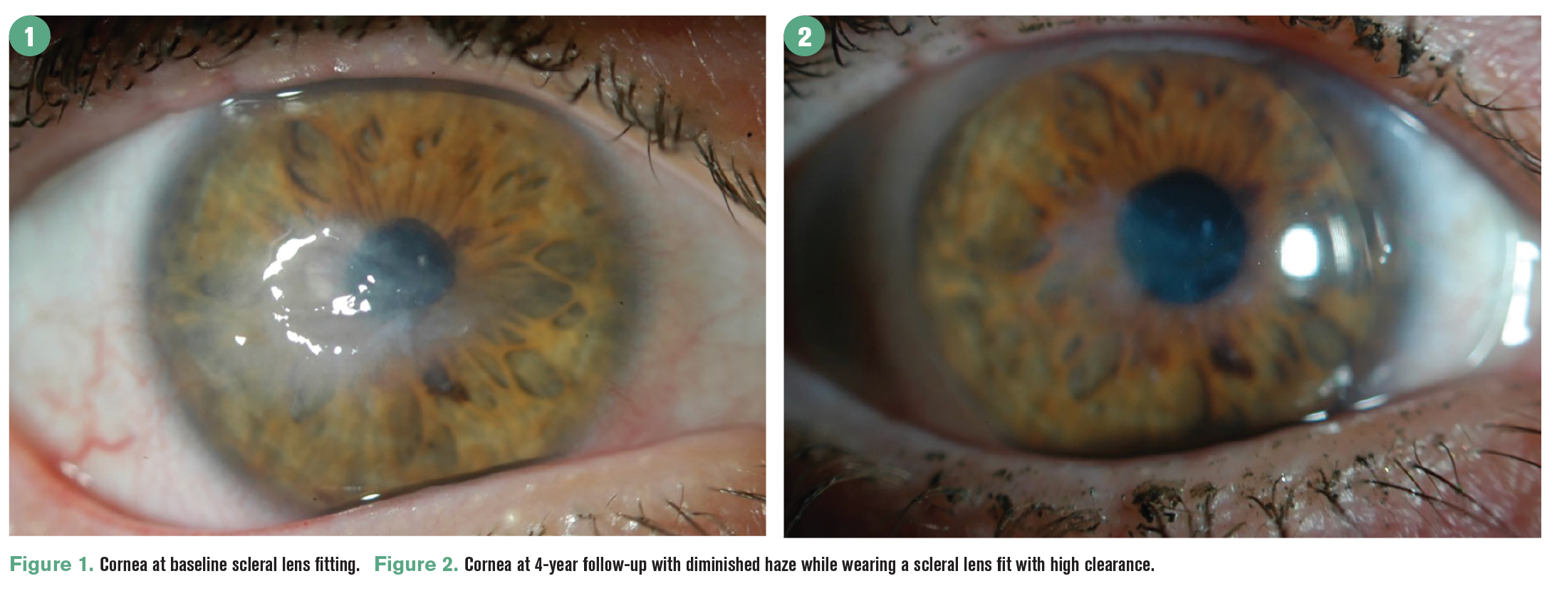 How to fit scleral lenses with confidence and caution