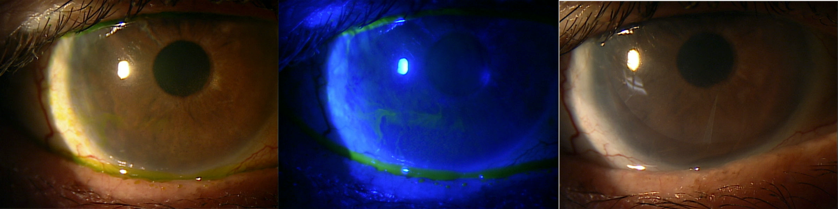  Amniotic membrane grafts help ocular surface disease