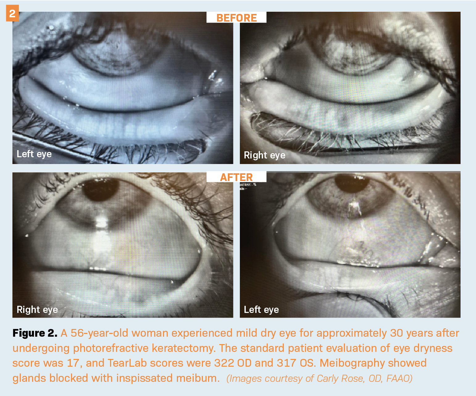 A 56-year-old woman experienced mild dry eye for approximately 30 years after undergoing photorefractive keratectomy. The standard patient evaluation of eye dryness score was 17, and TearLab scores were 322 OD and 317 OS. Meibography showed glands blocked with inspissated meibum.  (Images courtesy of Carly Rose, OD, FAAO)