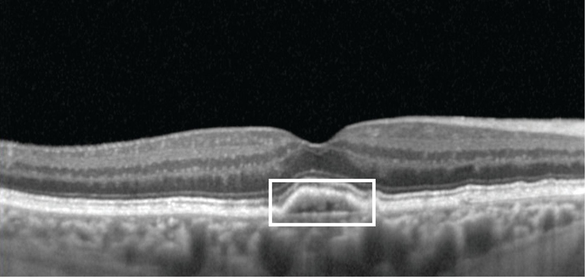 OCT biomarkers associated with advanced age-related macular degeneration