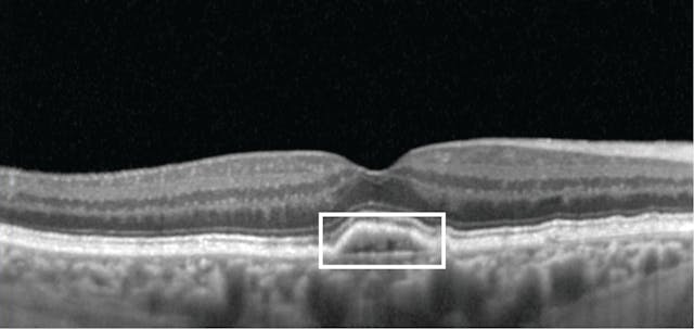 OCT biomarkers associated with advanced age-related macular degeneration