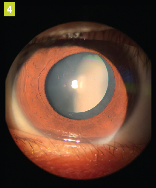 Figure 4. ICL at dilated post operative examination after 1 month.  (All images courtesy of Cecelia Koetting, OD, FAAO, Diplomat ABO)