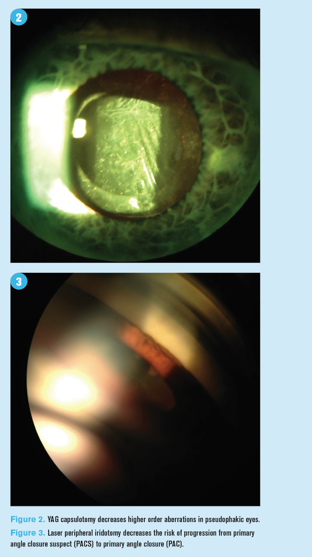 Quiz: New data in anterior segment laser surgery
