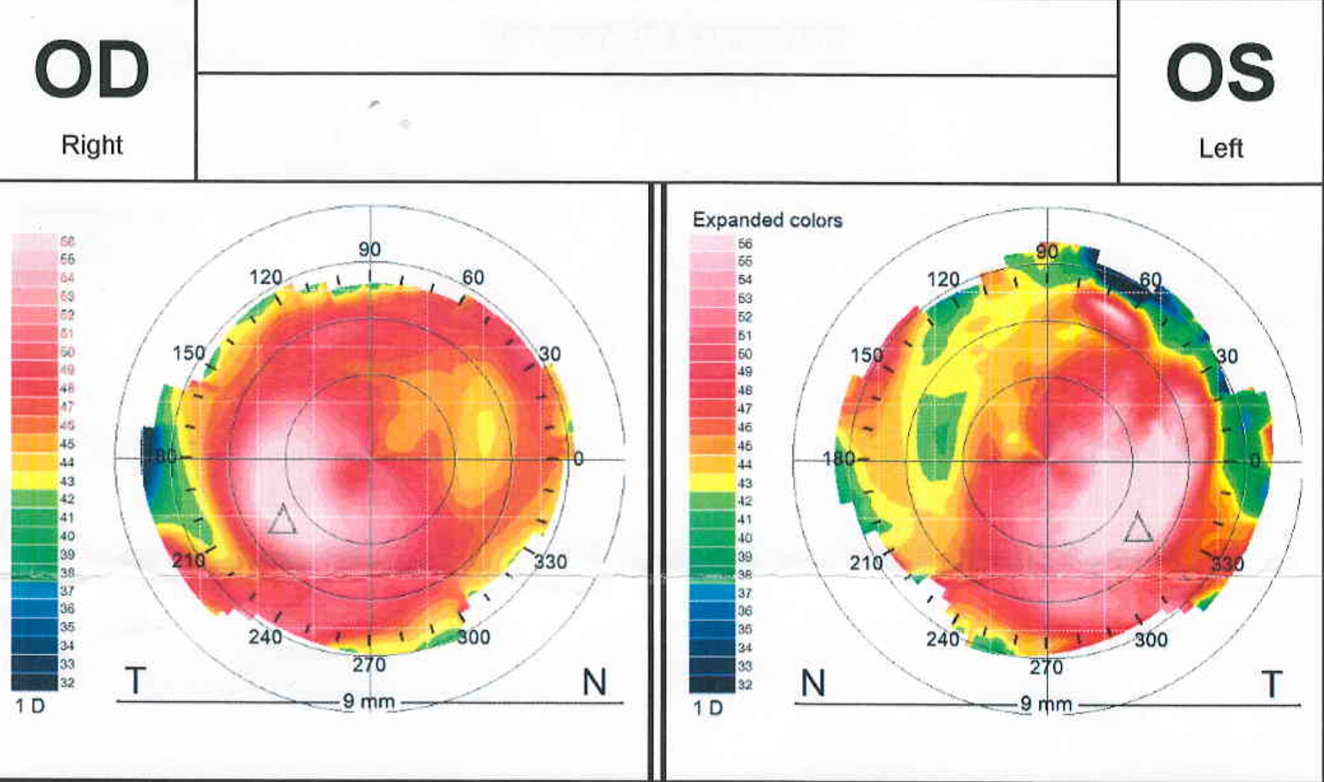Figure 1. Topography of the keratoconic patient in Case 1.