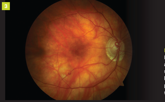 Figure 3.

Retinal issues such as microaneurysms should be evaluated by a retinal specialist prior to cataract surgery.
