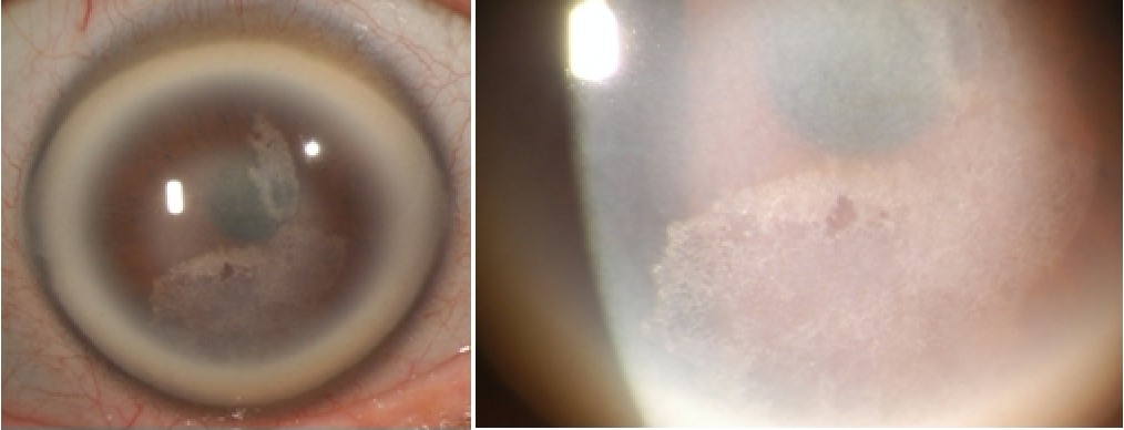  Figure 1. Corneal findings with dense arcus, central stromal haze, and subepith