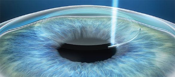 Will the SMILE procedure replace LASIK?