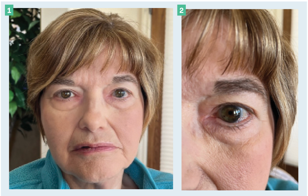 Figure 1. JL with typical facial droop following Bell palsy episode.  Figure 2. JL’s well-fitting scleral lens. The light blue handling tint is not noticeable cosmetically without high magnification but is certainly helpful for handling.