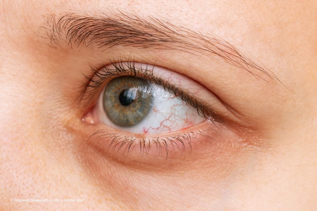 Dacryostenosis illustrates the complexity of treating teary eyes