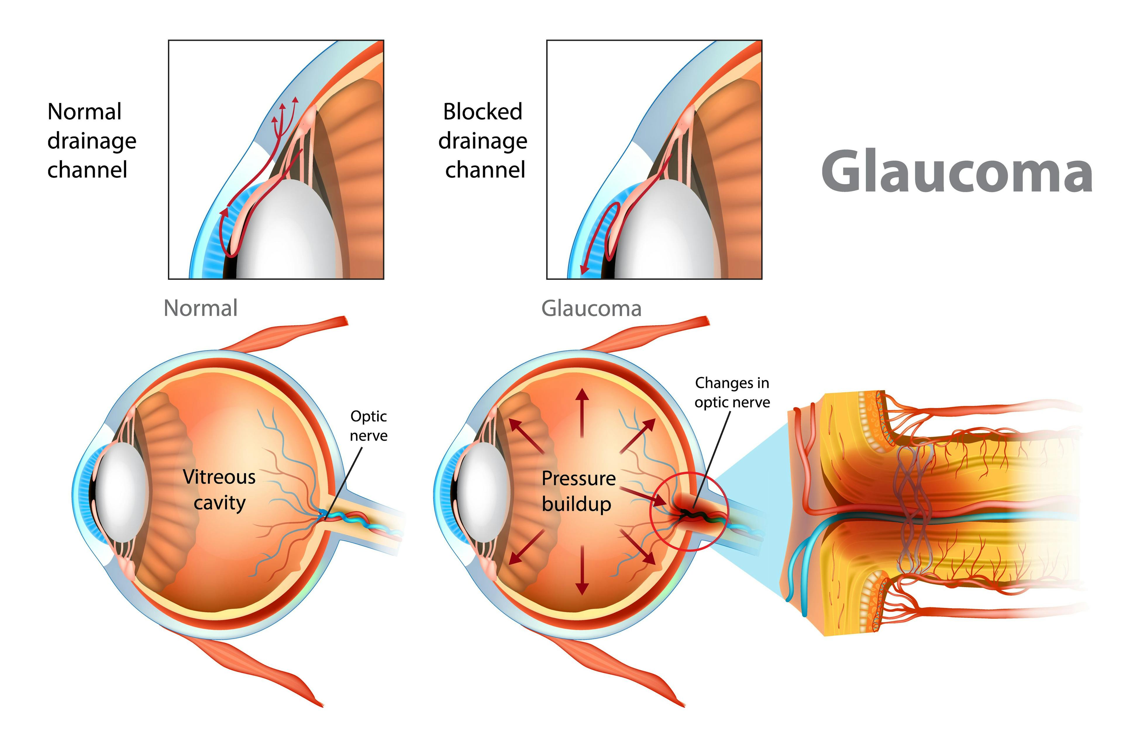 5 glaucoma management myths