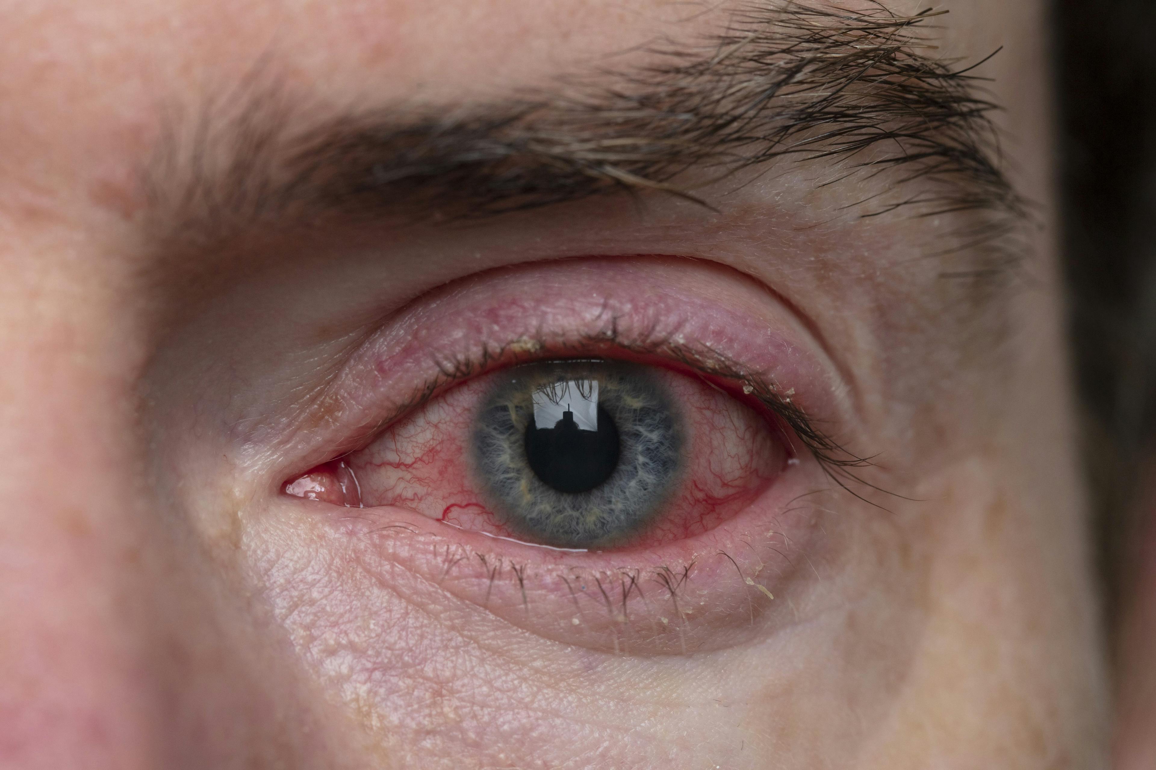 Ocular inflammation: When to drug, when to plug