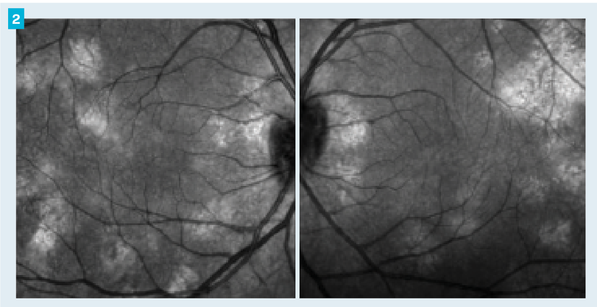 Figure 2. Infrared images on optical coherence tomography showed multiple bright choroidal lesions throughout the posterior pole of each eye.